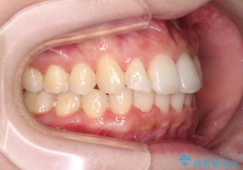 インビザラインを断念 ワイヤー装置で楽々と矯正治療の治療後