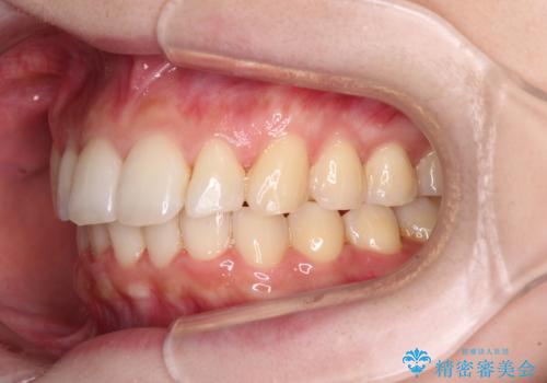 インビザラインを断念 ワイヤー装置で楽々と矯正治療の治療後