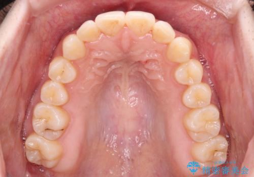 インビザラインを断念 ワイヤー装置で楽々と矯正治療の治療後