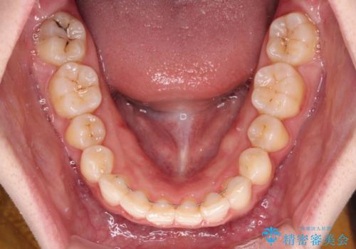 インビザラインを断念 ワイヤー装置で楽々と矯正治療の治療後