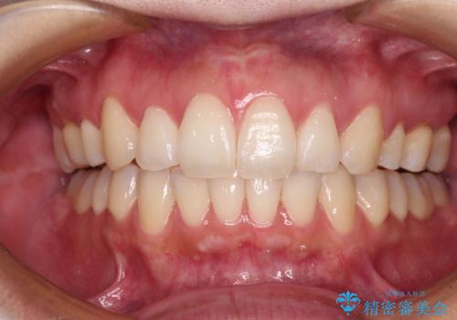 再矯正で突出した口元を引っ込める　抜歯矯正の後戻りの症例 治療後