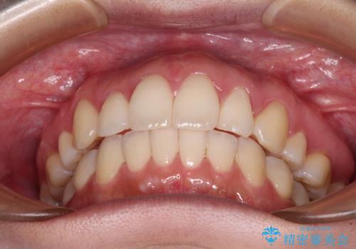 再矯正で突出した口元を引っ込める 抜歯矯正の後戻りの治療後
