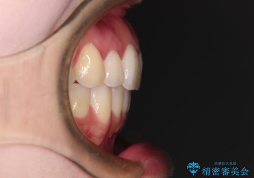 再矯正で突出した口元を引っ込める 抜歯矯正の後戻りの治療後