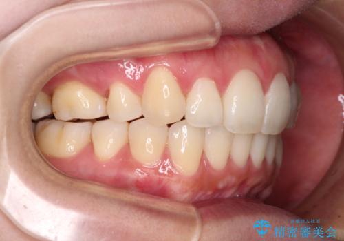 再矯正で突出した口元を引っ込める 抜歯矯正の後戻りの治療後