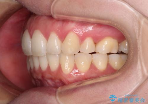 再矯正で突出した口元を引っ込める　抜歯矯正の後戻りの治療後