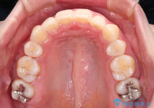 再矯正で突出した口元を引っ込める 抜歯矯正の後戻りの治療後