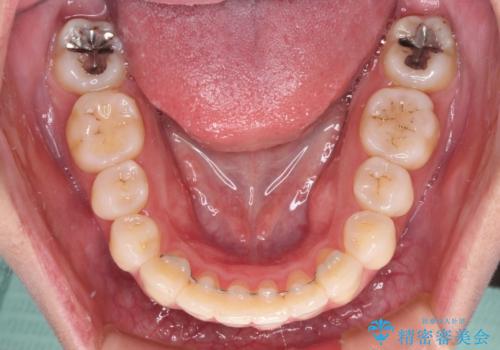 再矯正で突出した口元を引っ込める　抜歯矯正の後戻りの治療後