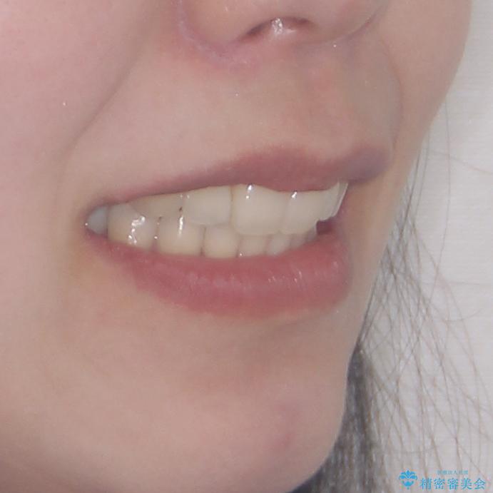 再矯正で突出した口元を引っ込める 抜歯矯正の後戻りの治療後(顔貌)