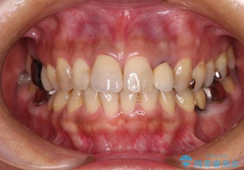 変色した保険クラウンをきれいに オールセラミッククラウンによる補綴治療の治療後