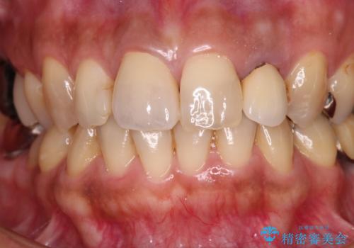 変色した保険クラウンをきれいに オールセラミッククラウンによる補綴治療の治療後
