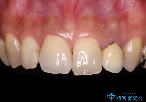 変色した保険クラウンをきれいに オールセラミッククラウンによる補綴治療の症例 治療後