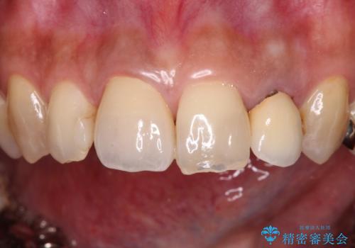 変色した保険クラウンをきれいに オールセラミッククラウンによる補綴治療の治療後