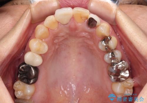 変色した保険クラウンをきれいに オールセラミッククラウンによる補綴治療の治療後