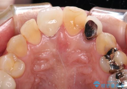 変色した保険クラウンをきれいに オールセラミッククラウンによる補綴治療の治療後