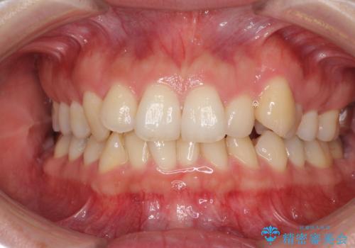 入国制限で帰国できず 海外出張中のインビザライン矯正の症例 治療前