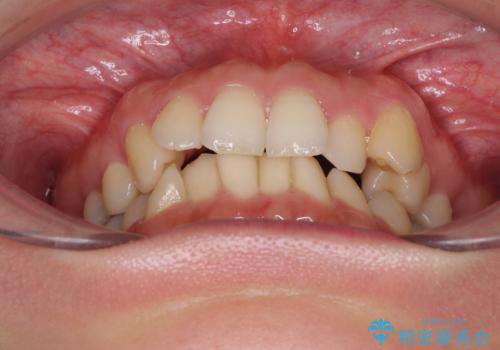 入国制限で帰国できず 海外出張中のインビザライン矯正の治療前