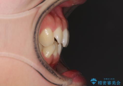 入国制限で帰国できず 海外出張中のインビザライン矯正の治療前