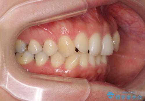 入国制限で帰国できず 海外出張中のインビザライン矯正の治療前