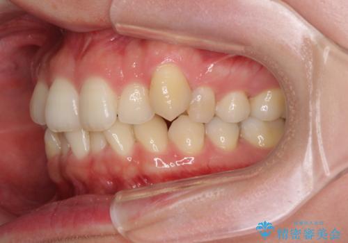 入国制限で帰国できず 海外出張中のインビザライン矯正の治療前