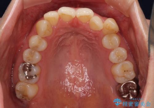 入国制限で帰国できず 海外出張中のインビザライン矯正の治療前