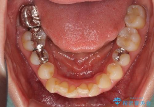 入国制限で帰国できず 海外出張中のインビザライン矯正の治療前