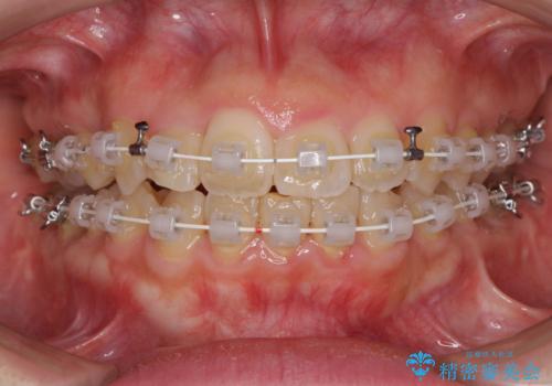 変則的な抜歯矯正 八重歯を抜いてしまった人のワイヤー矯正の治療中