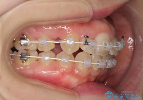 変則的な抜歯矯正 八重歯を抜いてしまった人のワイヤー矯正の治療中