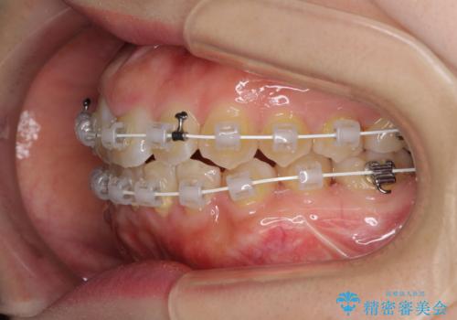 変則的な抜歯矯正　八重歯を抜いてしまった人のワイヤー矯正の治療中