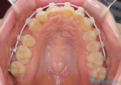 変則的な抜歯矯正 八重歯を抜いてしまった人のワイヤー矯正の治療中