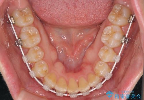 変則的な抜歯矯正　八重歯を抜いてしまった人のワイヤー矯正の治療中