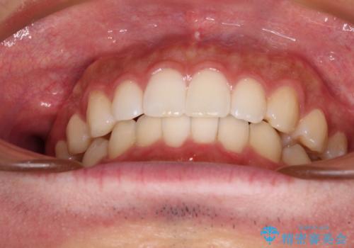 前歯のデコボコと突出感 インビザラインにて矯正治療の治療後