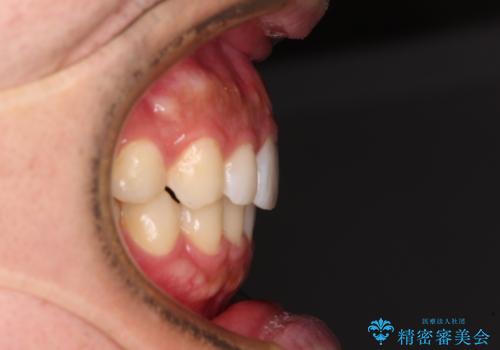 前歯のデコボコと突出感 インビザラインにて矯正治療の治療後
