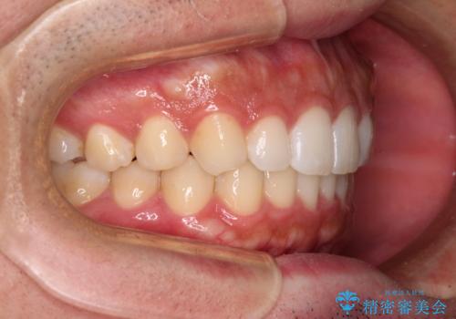 前歯のデコボコと突出感 インビザラインにて矯正治療の治療後