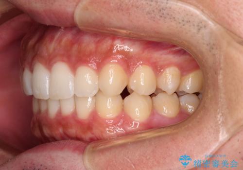 前歯のデコボコと突出感 インビザラインにて矯正治療の治療後