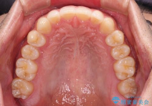 前歯のデコボコと突出感 インビザラインにて矯正治療の治療後