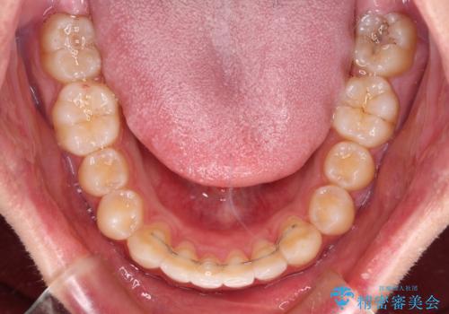 前歯のデコボコと突出感 インビザラインにて矯正治療の治療後