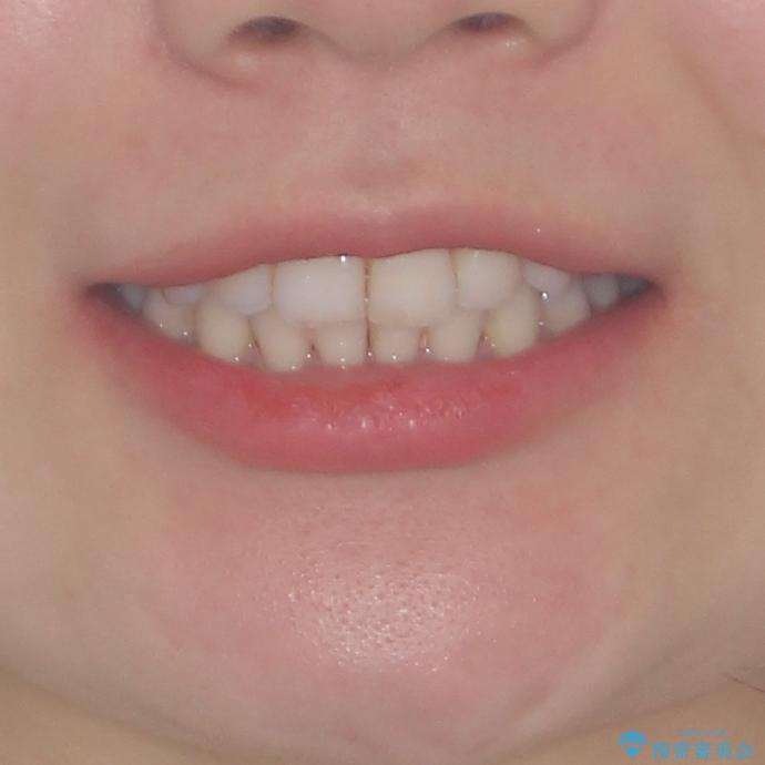 入国制限で帰国できず 海外出張中のインビザライン矯正の治療後(顔貌)