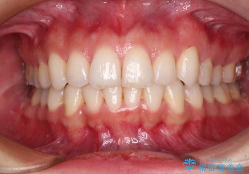 入国制限で帰国できず 海外出張中のインビザライン矯正