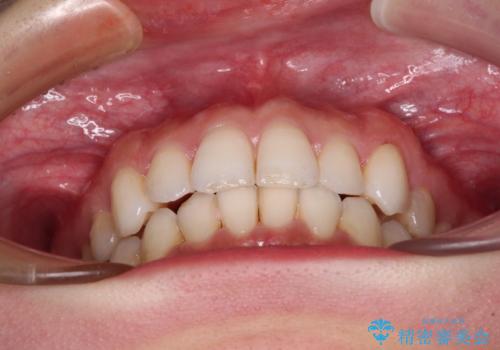 入国制限で帰国できず 海外出張中のインビザライン矯正の治療後