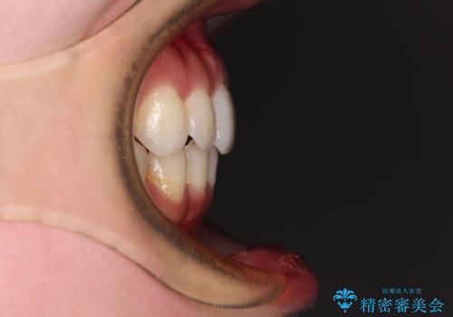 入国制限で帰国できず 海外出張中のインビザライン矯正の治療後