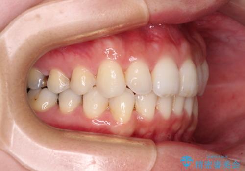 入国制限で帰国できず 海外出張中のインビザライン矯正の治療後