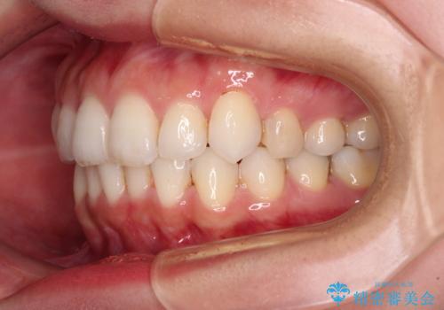 入国制限で帰国できず 海外出張中のインビザライン矯正の治療後