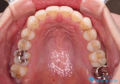 入国制限で帰国できず 海外出張中のインビザライン矯正の治療後