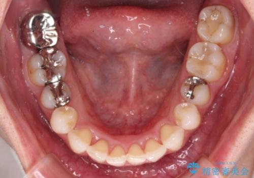 入国制限で帰国できず 海外出張中のインビザライン矯正の治療後