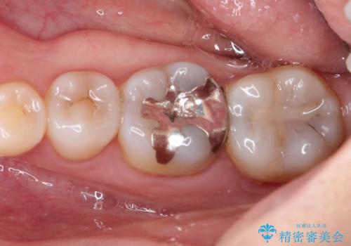 【セラミックインレー】虫歯の治療の症例 治療前
