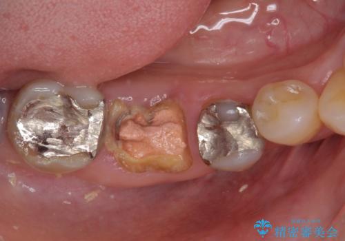 インプラントしかないと言われた　奥歯のオールセラミックブリッジの症例 治療前