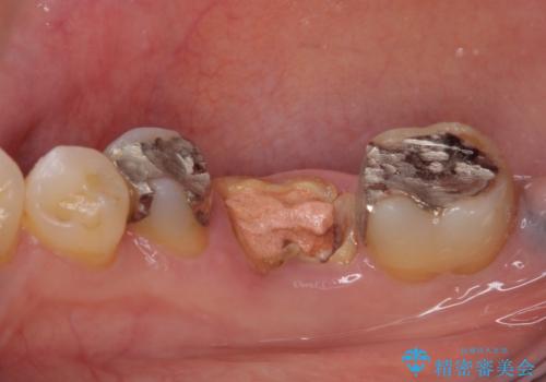 インプラントしかないと言われた 奥歯のオールセラミックブリッジの治療前