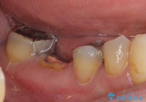 インプラントしかないと言われた 奥歯のオールセラミックブリッジの治療前