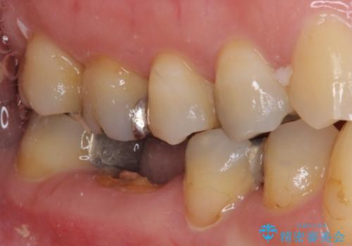 インプラントしかないと言われた 奥歯のオールセラミックブリッジの治療前