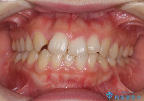 変則的な抜歯矯正　八重歯を抜いてしまった人のワイヤー矯正の症例 治療前